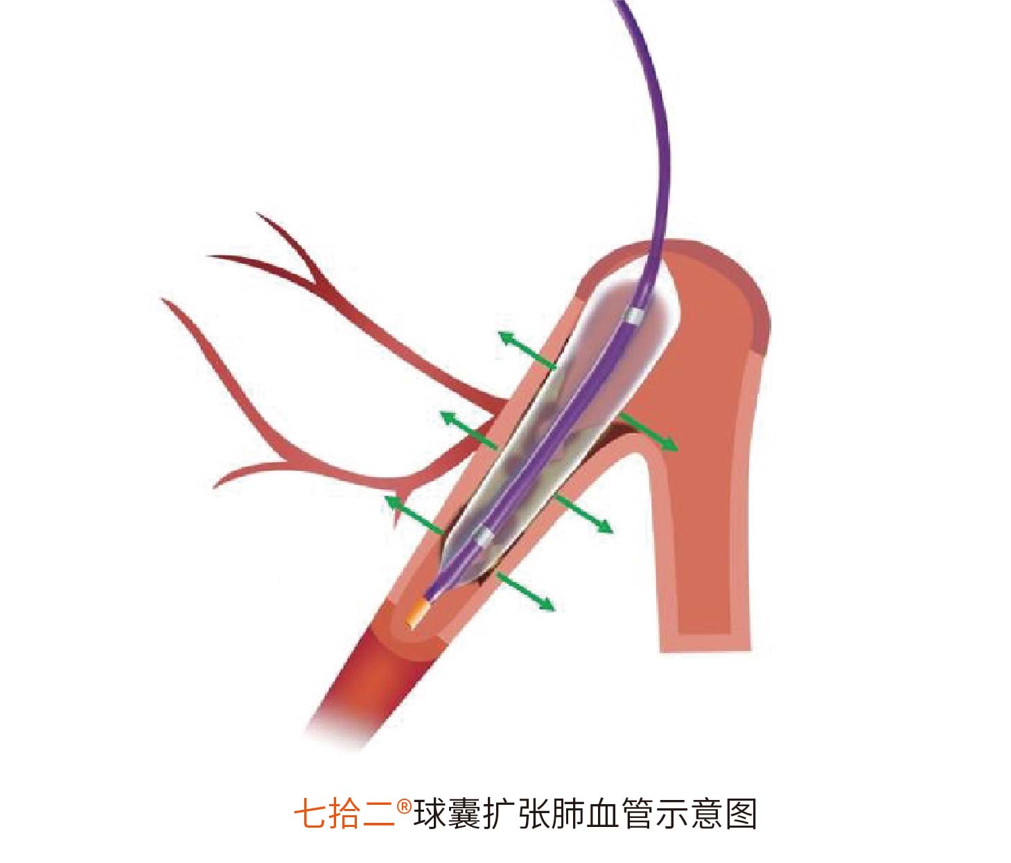 七拾二?Sev-changes 肺動脈球囊擴張導管(圖2)